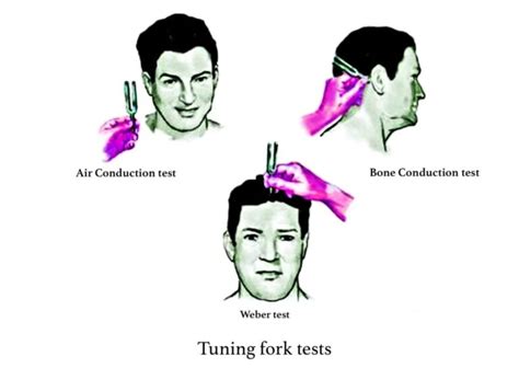 schwabach test|Tuning Fork Tests .